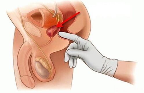 masaža prostate za prostatitis